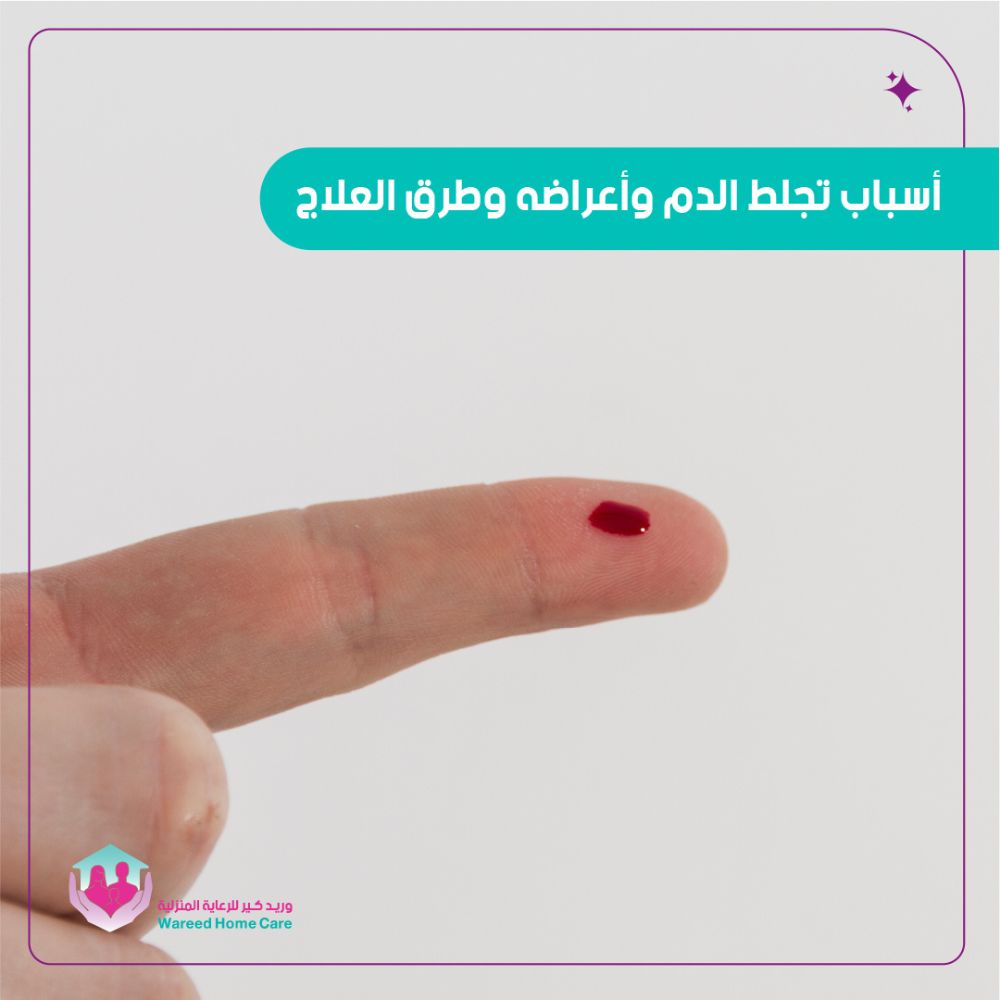 أسباب تجلط الدم وأعراضه وطرق العلاج