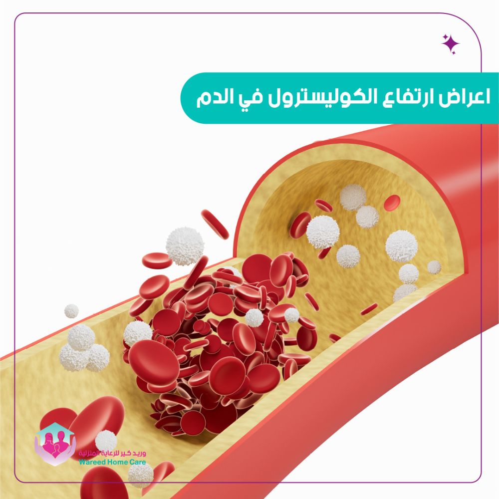 علامات تدل على ارتفاع الكوليسترول في الدم