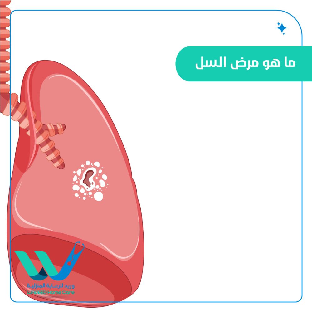 أعراض مرض السل وكيفية الوقاية منه