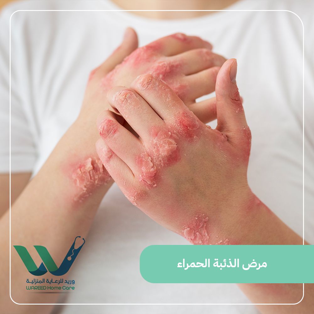 فهم مرض الذئبة الحمراء وأعراضه